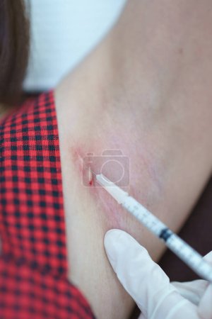 Téléchargez les photos : Closeup doctor injection treatment for keloids on the armpit. - en image libre de droit