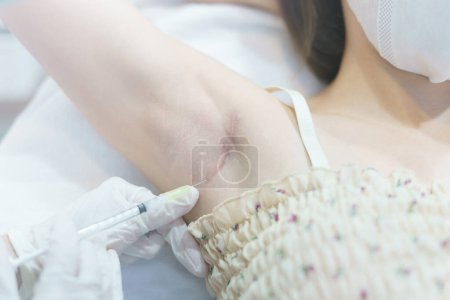 Téléchargez les photos : Gros plan médecin traitement par injection pour les keloïdes sur l'aisselle - en image libre de droit