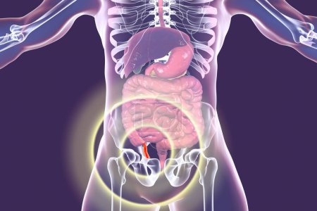 Téléchargez les photos : Illustration de l'appendicite aiguë 3d - en image libre de droit