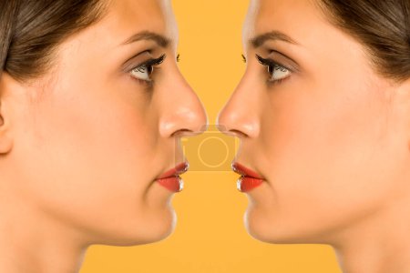Photo for Woman before and after nose surgery - Royalty Free Image