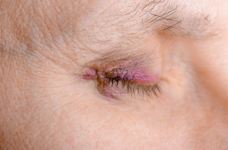 Photo for "Injured eye due to capillary rupture" - Royalty Free Image