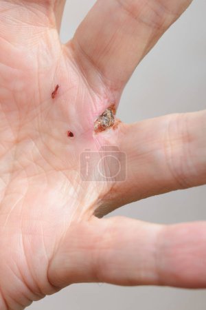 Foto de Rastros de mordedura de perro en los dedos - Imagen libre de derechos
