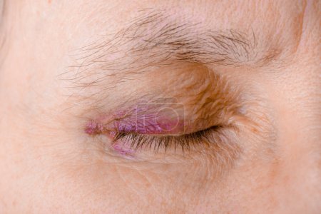 Téléchargez les photos : Injured eye due to capillary rupture - en image libre de droit