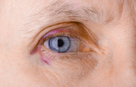 Photo for Injured eye due to capillary rupture - Royalty Free Image
