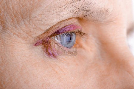 Photo for Injured eye due to capillary rupture - Royalty Free Image
