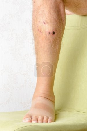 Téléchargez les photos : Gros plan de Traces de morsures de chien à la jambe - en image libre de droit