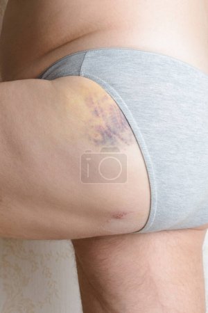 Photo for Traces of dog bite and hematoma to the buttock - Royalty Free Image