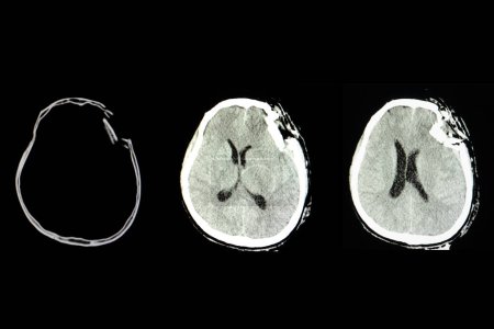 Foto de Lesión cerebral traumática, imagen escaneada - Imagen libre de derechos