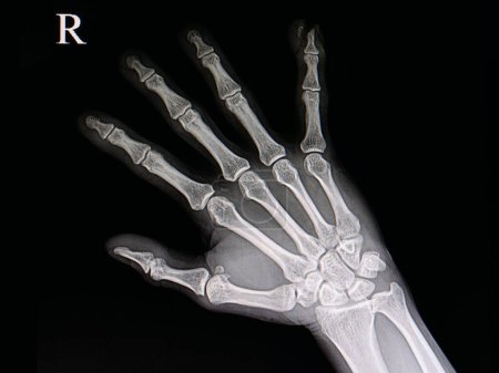 Foto de Lesión en la punta del dedo rayos X en el fondo, primer plano - Imagen libre de derechos