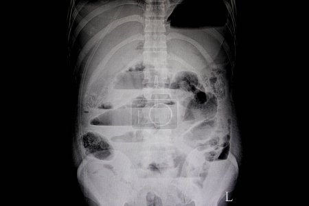 Téléchargez les photos : Occlusion intestinale mécanique rayons X sur le fond, gros plan - en image libre de droit