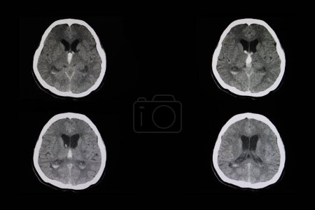 Foto de Radiografía de hemorragia intracerebral en el fondo, primer plano - Imagen libre de derechos