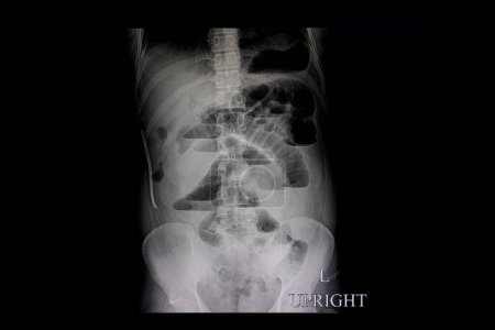 Téléchargez les photos : Occlusion intestinale mécanique radiographie sur fond, gros plan - en image libre de droit
