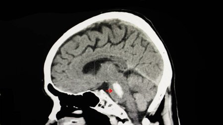 Foto de Radiografía de la hemorragia pontina en el fondo, primer plano - Imagen libre de derechos