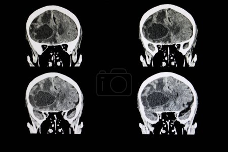 Téléchargez les photos : Tumeur cérébrale métastatique radiographie sur fond, gros plan - en image libre de droit