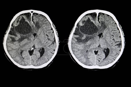 Foto de Radiografía metastásica del tumor cerebral en el fondo, primer plano - Imagen libre de derechos