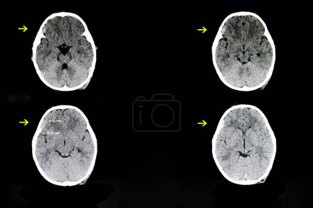 Photo for Child with subdural hematoma, scan image - Royalty Free Image
