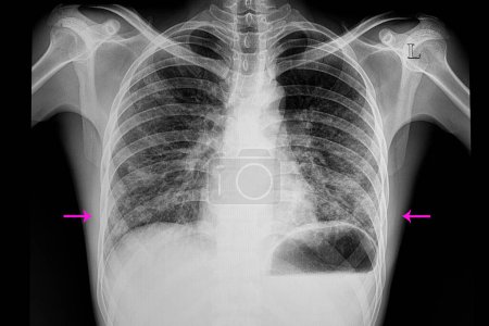Téléchargez les photos : Pneumonie bilatérale des poumons inférieurs - en image libre de droit