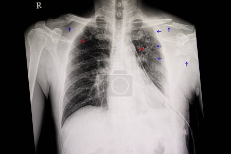 Photo for Chest film with multiple fracture - Royalty Free Image
