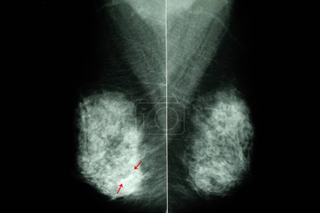 Téléchargez les photos : Mammographie des seins féminins radiographie sur fond, gros plan - en image libre de droit