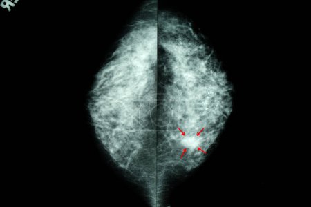 Photo for Mammogram of female breasts, scan image - Royalty Free Image