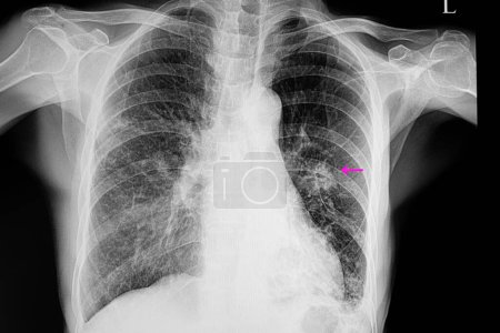 Foto de Neumonía y radiografía de nódulo pulmonar sobre fondo, primer plano - Imagen libre de derechos