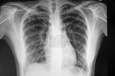 Foto de Radiografía de tuberculosis pulmonar en segundo plano, primer plano - Imagen libre de derechos