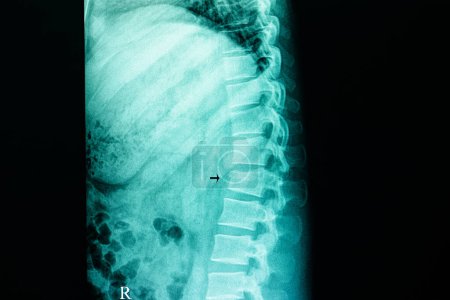 Téléchargez les photos : Fracture par compression de la colonne lombaire radiographie sur fond, gros plan - en image libre de droit