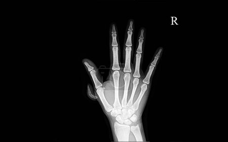 Photo for Polydactyly hand x-ray on background, close up - Royalty Free Image