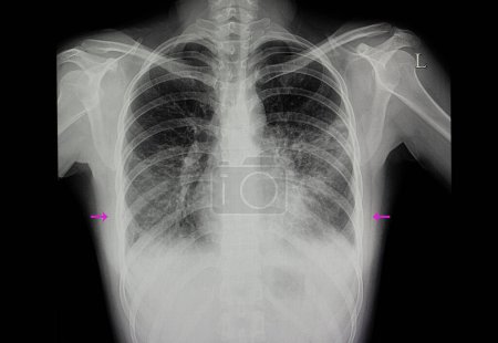 Foto de Un paciente con ambos pulmones neumonía rayos X en el fondo, de cerca - Imagen libre de derechos