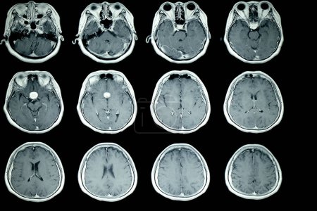 Foto de Resonancia magnética de la radiografía cerebral del paciente en el fondo, primer plano - Imagen libre de derechos