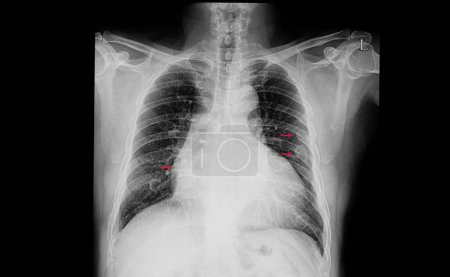 Foto de Cardiomegalia y múltiples fracturas de costillas, imagen escaneada - Imagen libre de derechos