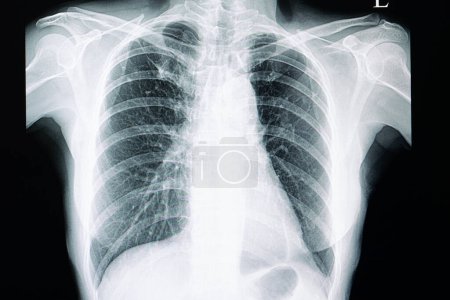 Foto de Radiografía de tuberculosis pulmonar en segundo plano, primer plano - Imagen libre de derechos