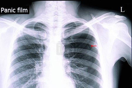Téléchargez les photos : Pneumothorax spontané radiographie sur fond, gros plan - en image libre de droit