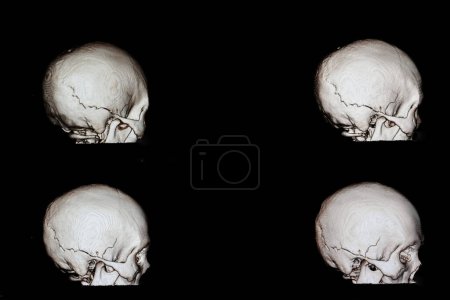 Foto de Fractura de cráneo película de rayos X en el fondo, de cerca - Imagen libre de derechos