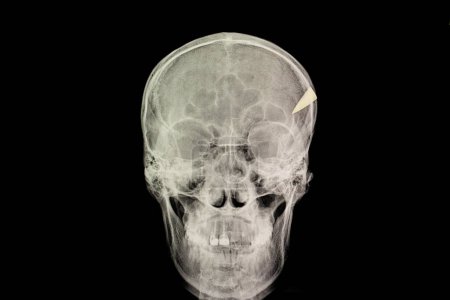 Foto de Lesión de la penetración del cráneo rayos X en el fondo, primer plano - Imagen libre de derechos