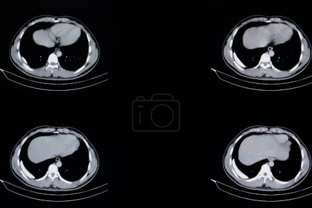 Photo for Pulmonary mass x-ray on background, close up - Royalty Free Image