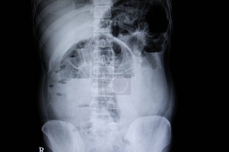 Foto de Radiografía de la película de obstrucción intestinal en el fondo, primer plano - Imagen libre de derechos