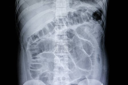Foto de Radiografía de la película de obstrucción intestinal en el fondo, primer plano - Imagen libre de derechos