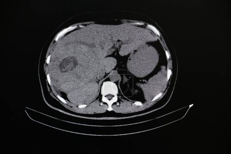 Foto de Una gran masa hepática de rayos X en el fondo, de cerca - Imagen libre de derechos