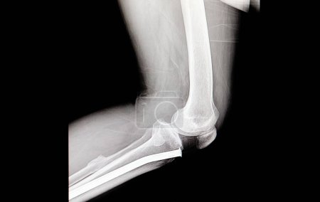 Foto de Clavo ortopédico en la radiografía de tibia en el fondo, de cerca - Imagen libre de derechos