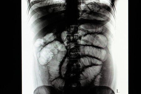 Téléchargez les photos : Film iléus intestinal radiographie sur fond, gros plan - en image libre de droit