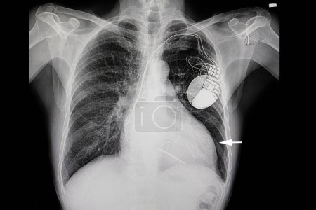 patient with heart enlargement and a cardiac pacemaker