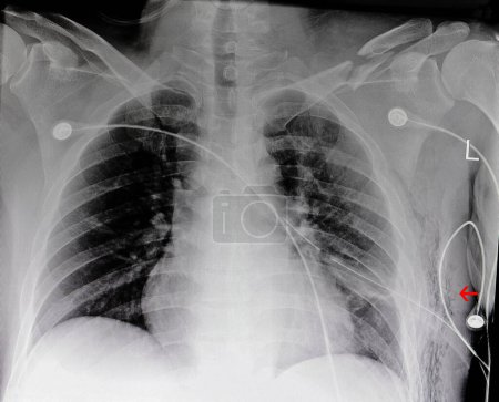 Téléchargez les photos : Emphysème sous-cutané radiographie sur fond, gros plan - en image libre de droit