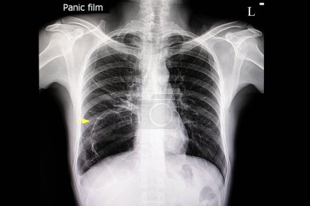 Téléchargez les photos : Souffle dans le poumon droit radiographie sur fond, gros plan - en image libre de droit