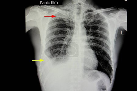 Photo for Pulmonary tuberculosis with pleural effusion - Royalty Free Image