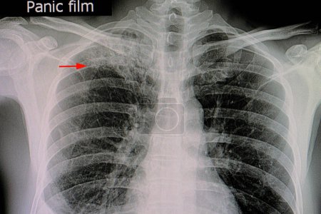 Téléchargez les photos : Tuberculose pulmonaire dans le poumon supérieur droit - en image libre de droit