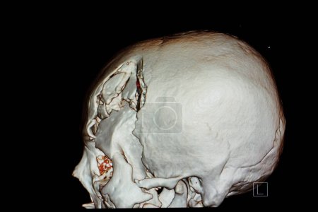 Foto de Película de representación 3D de un cráneo de paciente con lesión cerebral traumática - Imagen libre de derechos