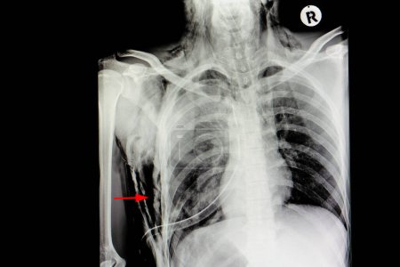 Foto de Enfisema subcutáneo derecho y contusión pulmonar - Imagen libre de derechos