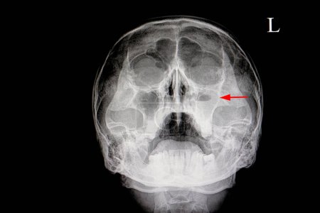 Téléchargez les photos : Sinusite maxillaire aiguë, image scan - en image libre de droit