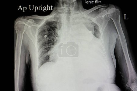 Photo for Massive pleural effusion x-ray on background, close up - Royalty Free Image